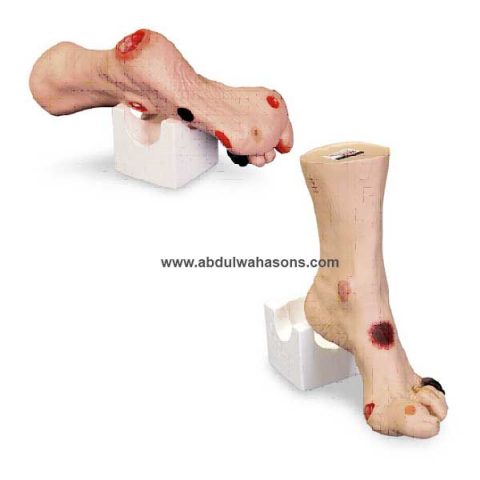 Wound Foot
